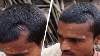 Bihar Doctor Uses Stapler Pins Instead of Stitches for Head Injury, Video Goes Viral